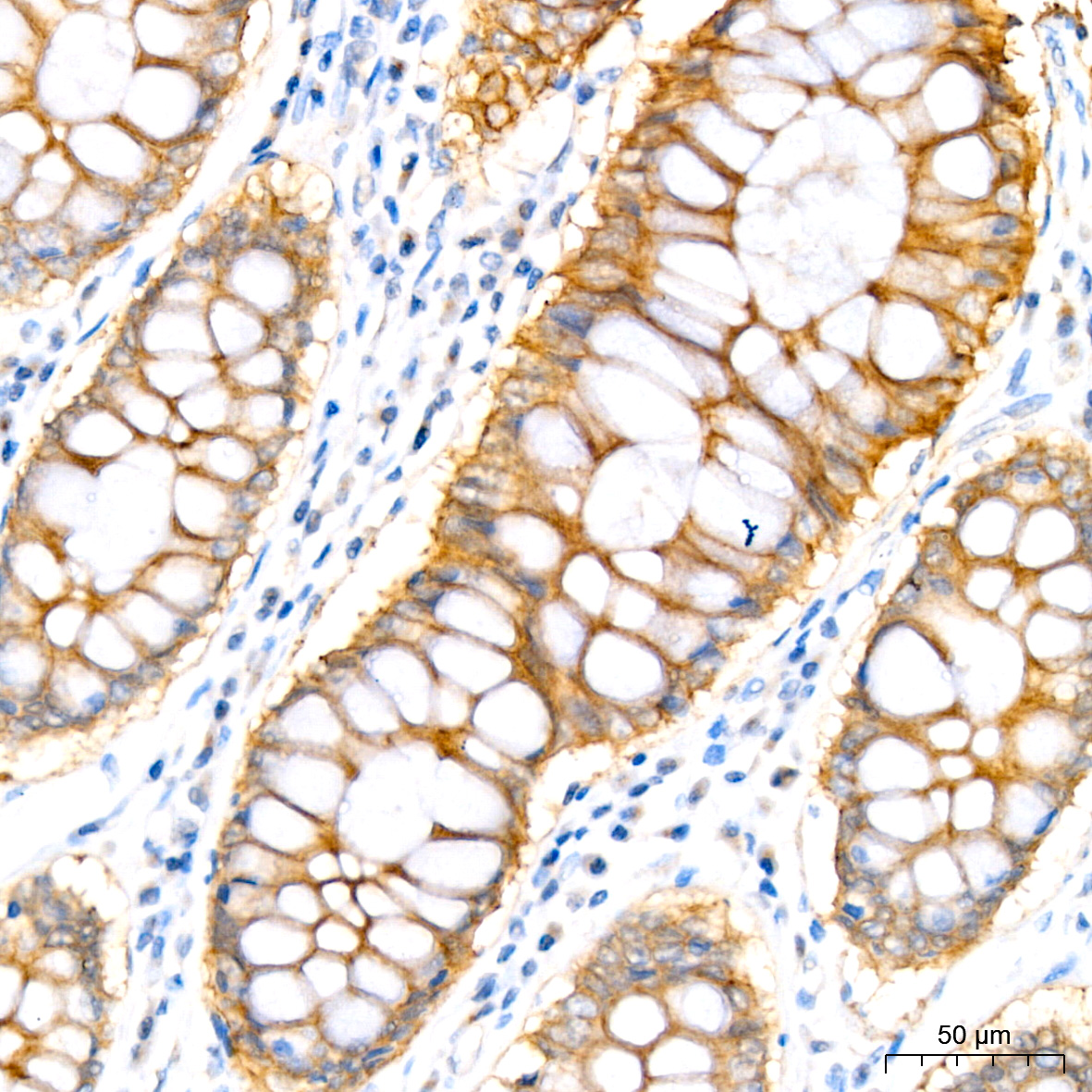 Immunohistochemistry analysis of paraffin-embedded Human colon carcinoma tissue using PER1 Rabbit mAb at a dilution of 1:300 (40x lens). High pressure antigen retrieval performed with 0.01M Citrate Buffer (pH 6.0) prior to IHC staining.