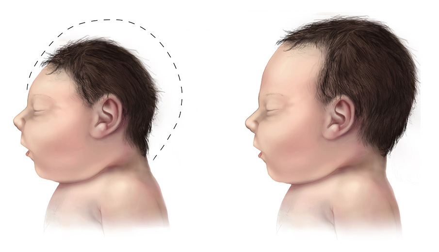 Zika Virus Microcephaly