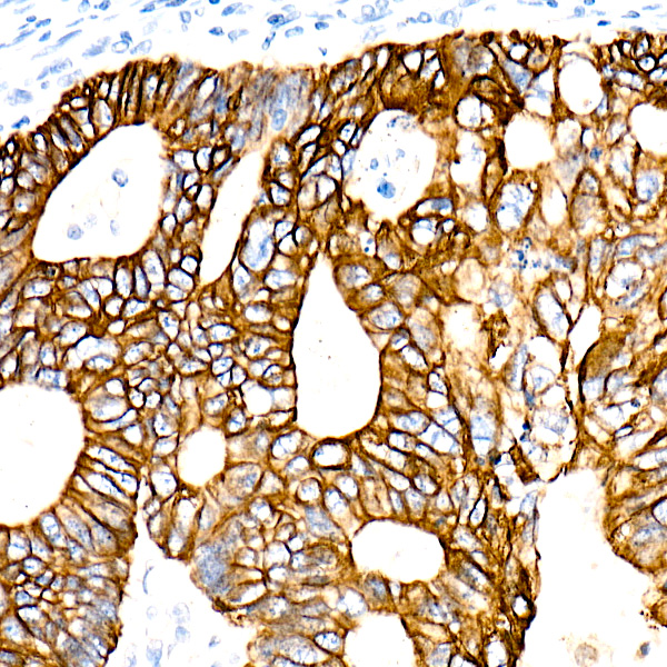 Immunohistochemistry analysis of paraffin-embedded Human colon carcinoma tissue using Cytokeratin 19 (KRT19) Rabbit mAb at a dilution of 1:100 (40x lens). Microwave antigen retrieval performed with 0.01M PBS Buffer (pH 7.2) prior to IHC staining.