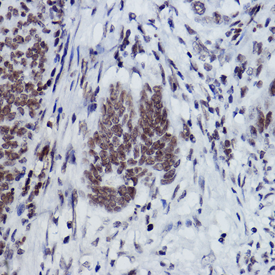 Immunohistochemistry analysis of paraffin-embedded Human colon carcinoma using MonoMethyl-Histone H2B-K116 Rabbit mAb at dilution of 1:100 (40x lens). High pressure antigen retrieval performed with 0.01M Citrate buffer (pH 6.0) prior to IHC staining.