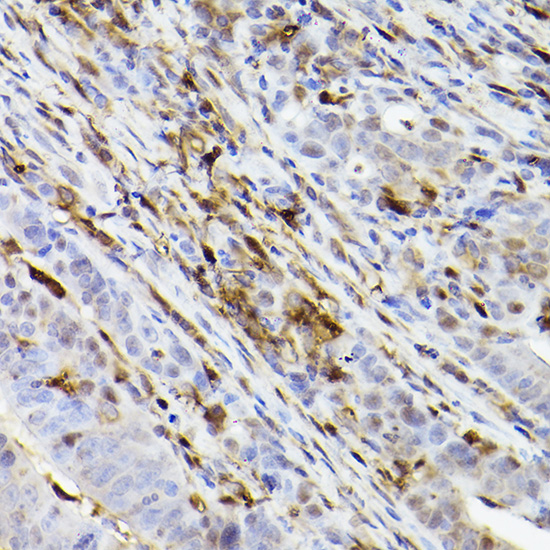 Immunohistochemistry analysis of paraffin-embedded Human colon carcinoma using Ferritin Heavy Chain Rabbit mAb at dilution of 1:100 (40x lens). High pressure antigen retrieval performed with 0.01M Citrate buffer (pH 6.0) prior to IHC staining.