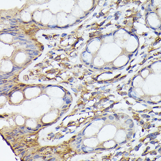 Immunohistochemistry analysis of paraffin-embedded Human colon using NF-kB p65/RelA Rabbit mAb at dilution of 1:100 (40x lens). High pressure antigen retrieval performed with 0.01M Citrate buffer (pH 6.0) prior to IHC staining.