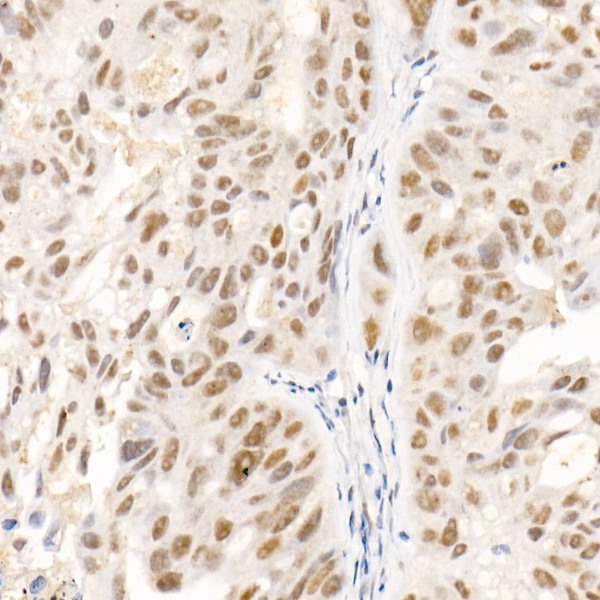Immunohistochemistry analysis of paraffin-embedded Human colon carcinoma tissue using SOCS1 Rabbit mAb at a dilution of 1:100 (40x lens). High pressure antigen retrieval performed with 0.01M Tris-EDTA Buffer (pH 9.0) prior to IHC staining.