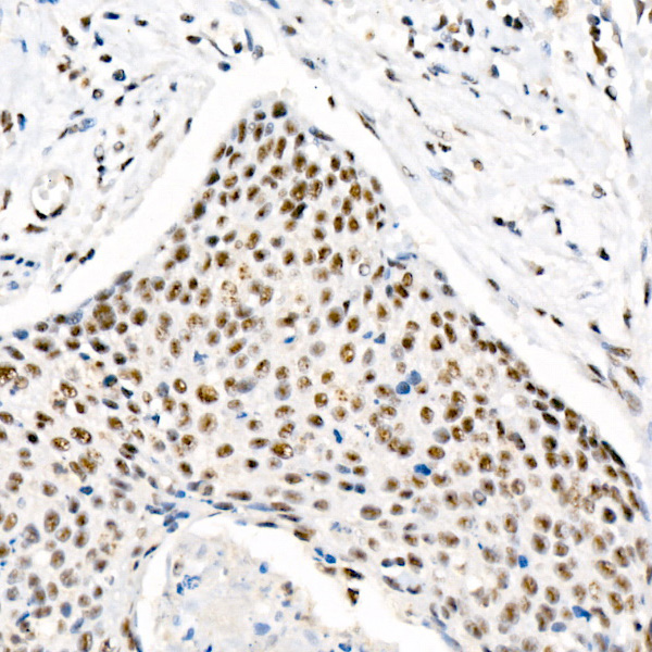 Immunohistochemistry analysis of paraffin-embedded Human cervix cancer using Phospho-Chk2-T68 Rabbit mAb at dilution of 1:1000 (40x lens). High pressure antigen retrieval performed with 0.01M Citrate buffer (pH 6.0) prior to IHC staining.