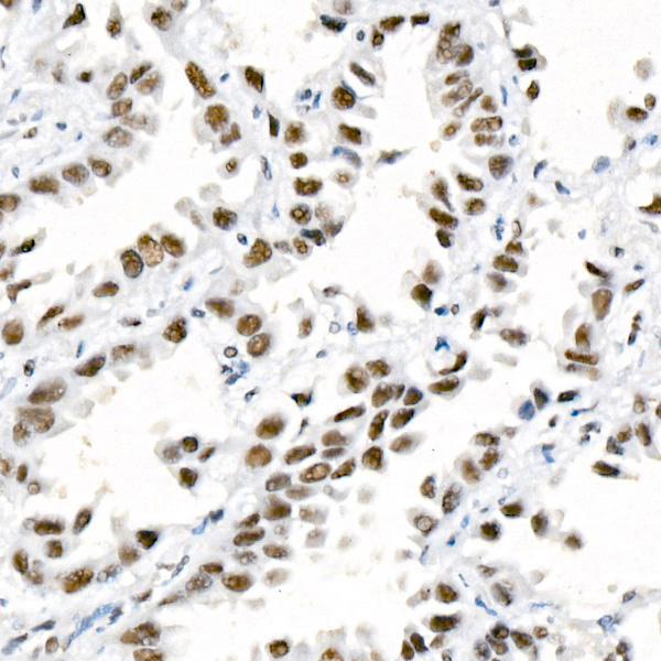 Immunohistochemistry analysis of paraffin-embedded Human lung cancer tissue using DNA-PKcs Rabbit mAb at a dilution of 1:100 (40x lens). High pressure antigen retrieval performed with 0.01M Citrate Buffer (pH 6.0) prior to IHC staining.
