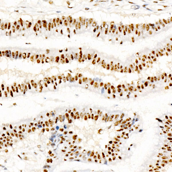 Immunohistochemistry analysis of paraffin-embedded Human colon carcinoma using Phospho-CREB1-S133 Rabbit mAb at dilution of 1:100 (40x lens). High pressure antigen retrieval performed with 0.01M Citrate buffer (pH 6.0) prior to IHC staining.