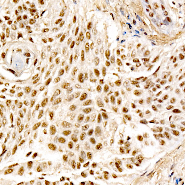 Immunohistochemistry analysis of paraffin-embedded Human lung squamous carcinoma tissue using MDM2 Rabbit mAb at dilution of 1:100 (40x lens). High pressure antigen retrieval performed with 0.01M Citrate buffer (pH 6.0) prior to IHC staining.