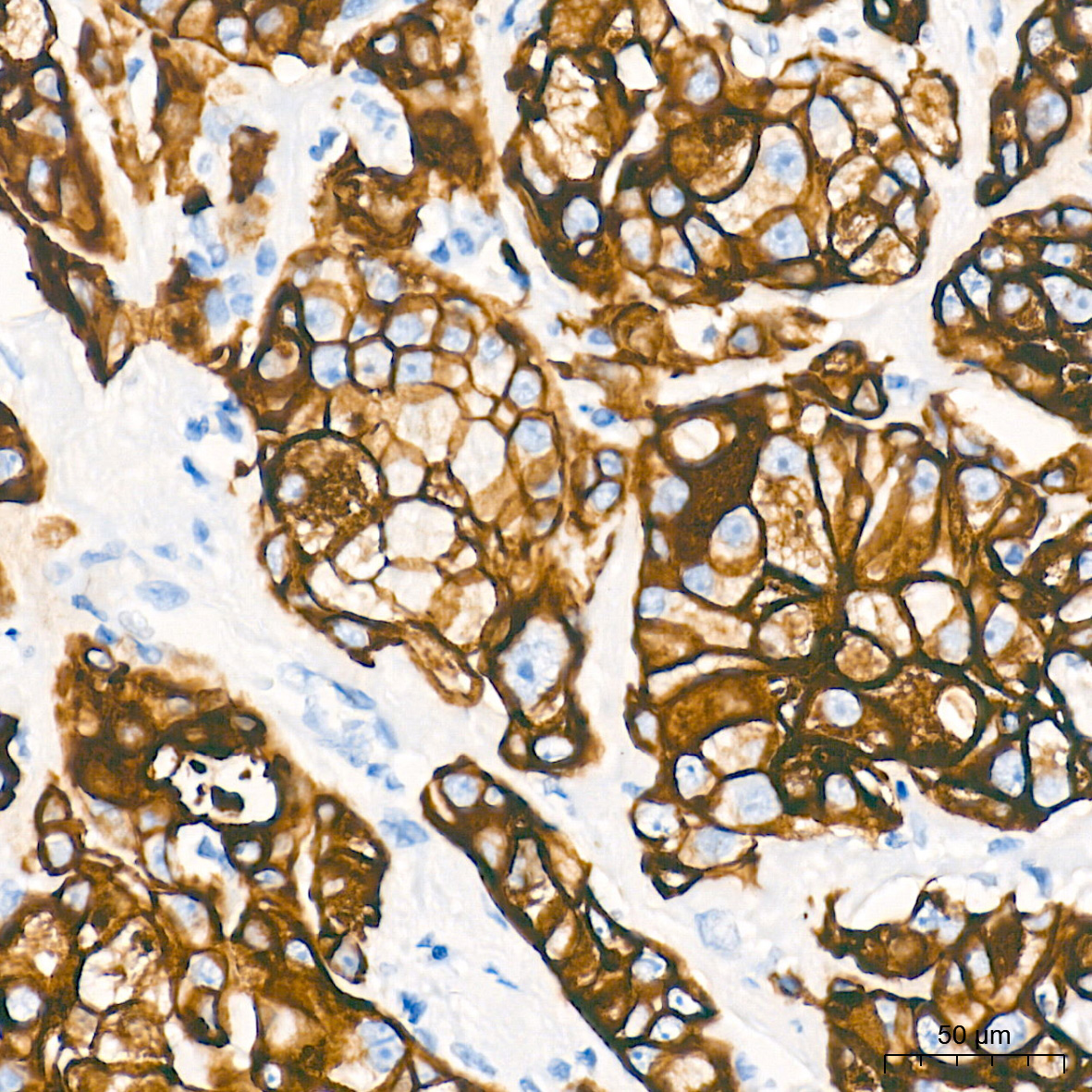 Immunohistochemistry analysis of paraffin-embedded Human breast cancer tissue using Cytokeratin AE1 Rabbit mAb at a dilution of 1:2000 (40x lens). High pressure antigen retrieval performed with 0.01M Tris-EDTA Buffer (pH 9.0) prior to IHC staining.